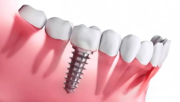 Implant dentaire Sidi Maârouf Casablanca