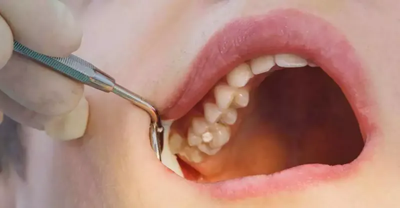 Soins des caries dentiste Casablanca